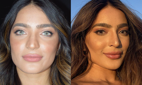 cheek filler facial contouring before after mississauga oakville